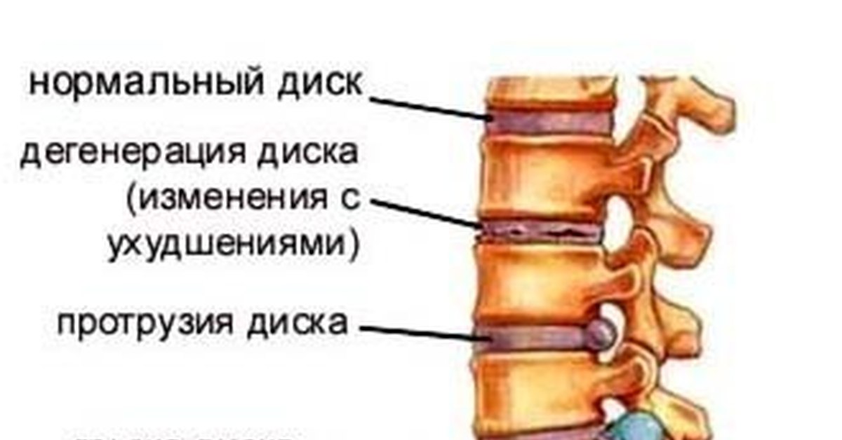 Может ли уменьшиться межпозвоночная грыжа 85